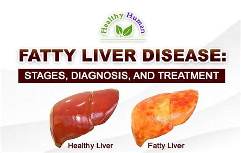 liver care near roseville|Fatty Liver Disease Care .